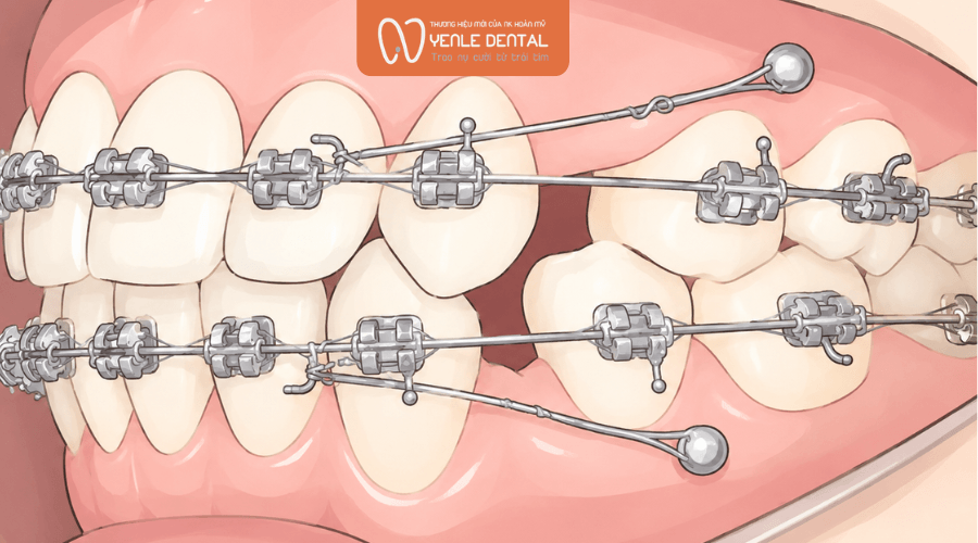 bắt vít khi niềng răng